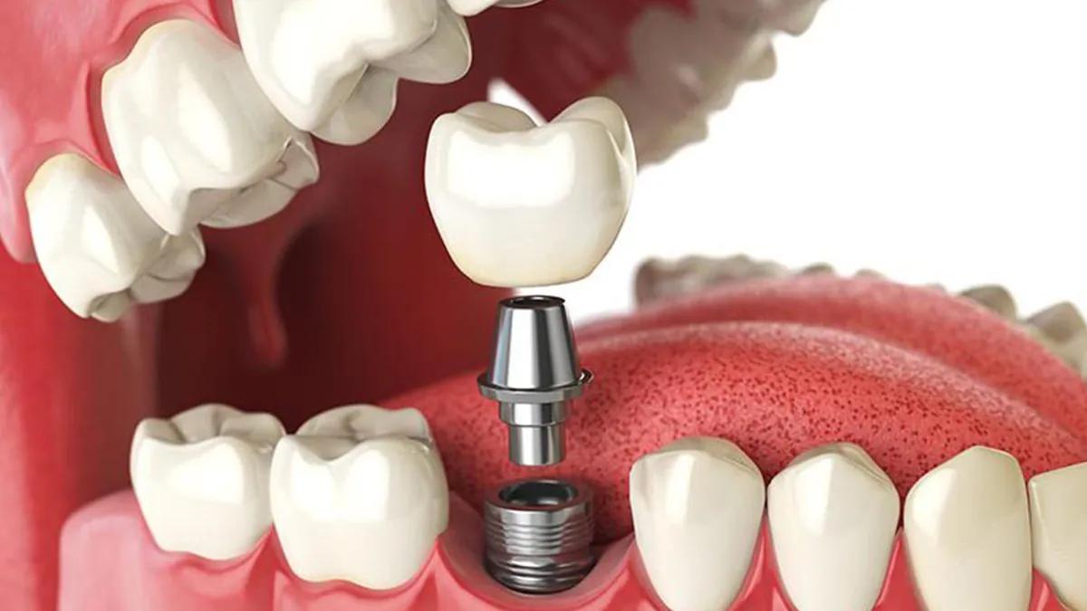 Modelo 3D de implante dental com gengiva digital